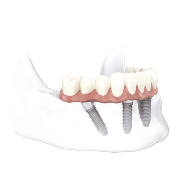Tipos de implantes dentales disponibles en las clínicas de Corral y Vargas en Jaén y Granada