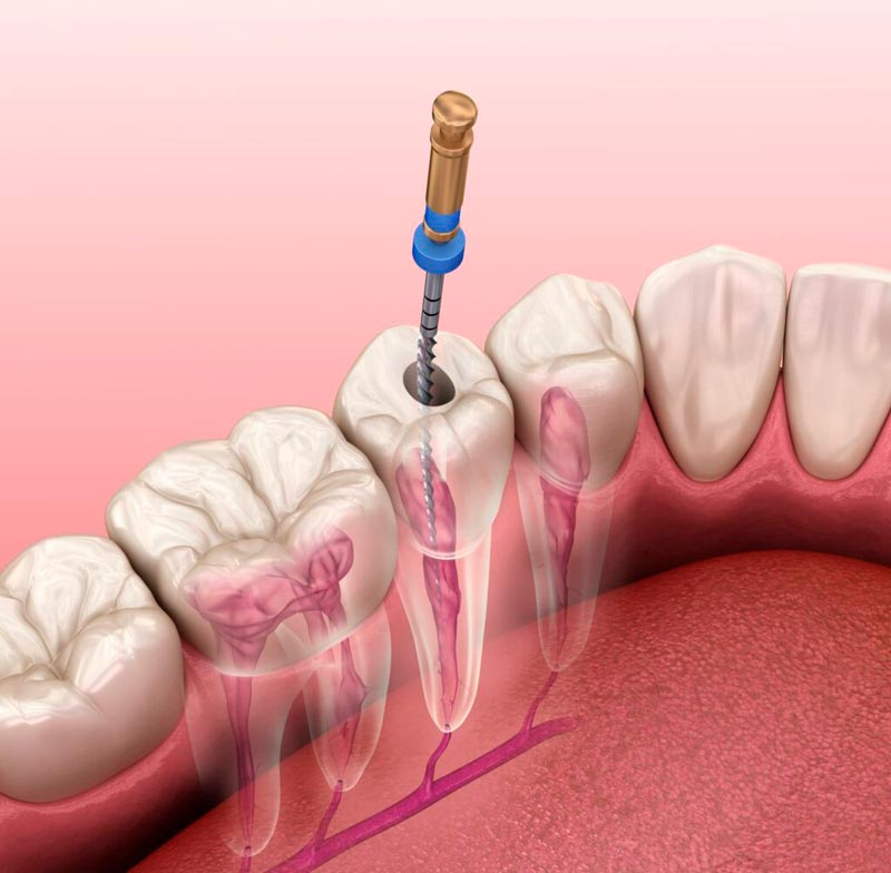 Consulta con los doctores Corral y Vargas en su clínica dental de Jaén sobre los tratamientos de endodoncia