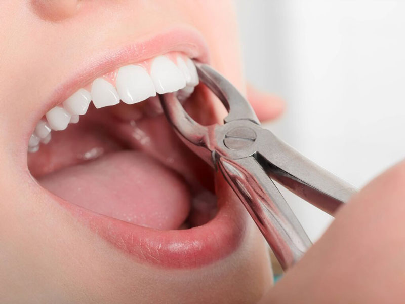 Tratamientos de odontología general como extracciones dentales con Corral y Vargas en la ciudad de Granada