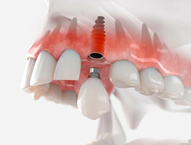 Todo lo que debes saber sobre los implantes dentales de clínica Corral y Vargas en Granada y Jaén