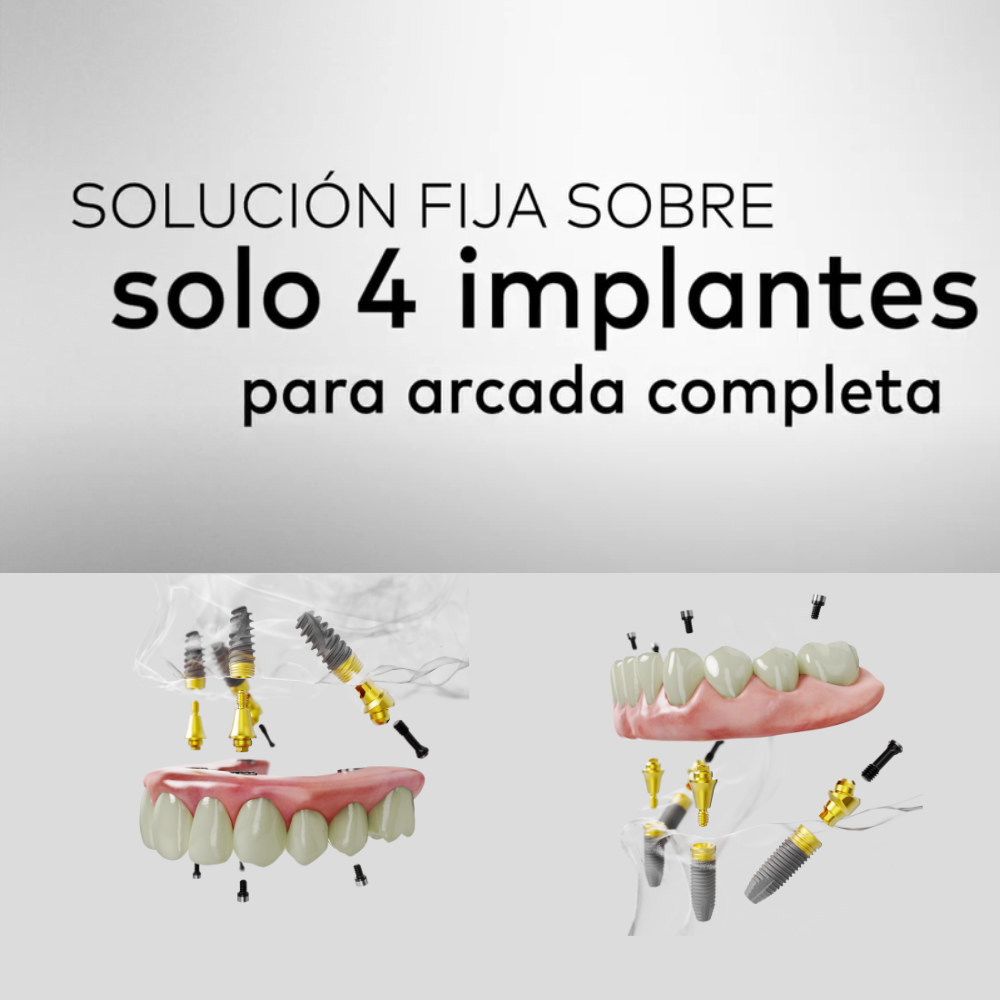 Solución fija sobre cuatro implantes dentales para arcada completa en la clínica dental Corral y Vargas en Jaén y Granada