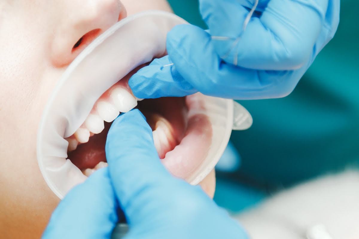 Perno dental qué es, cuándo se ponen y tipología