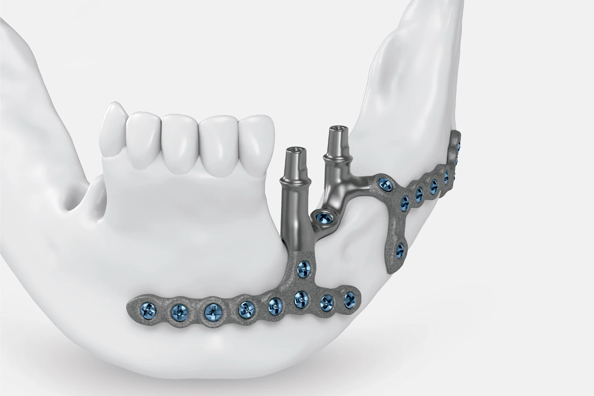 Implantes Subperi sticos Personalizados C V Granada